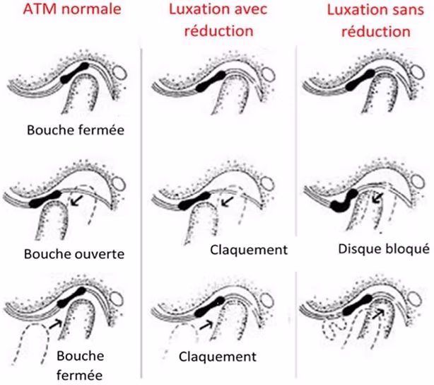 Schéma luxation discale articulation temporo-mandibulaire ATM traitement ostéopathique