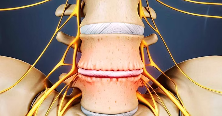 Rachis lombaire dégénératif L4-L5