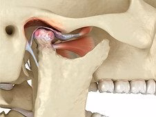 Schéma anatomique articulation temporo-mandibulaire ATM