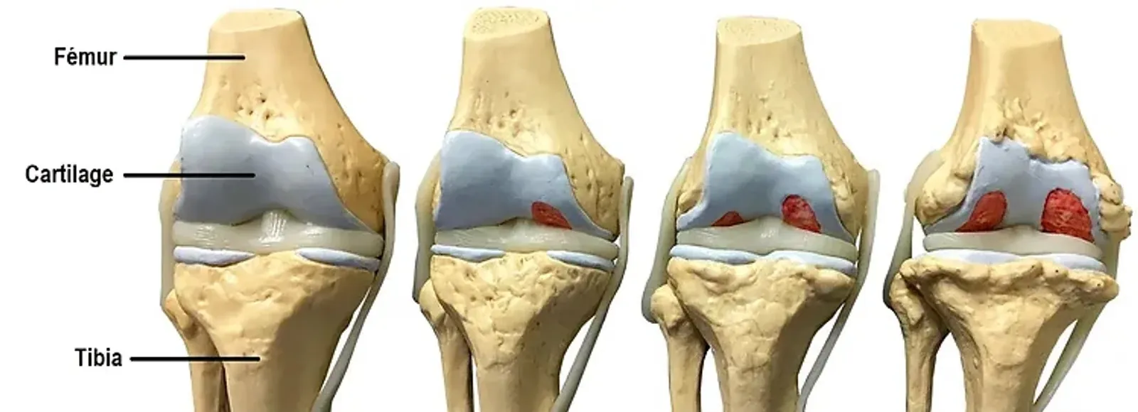 Knee osteoarthritis, osteopath Paris 16