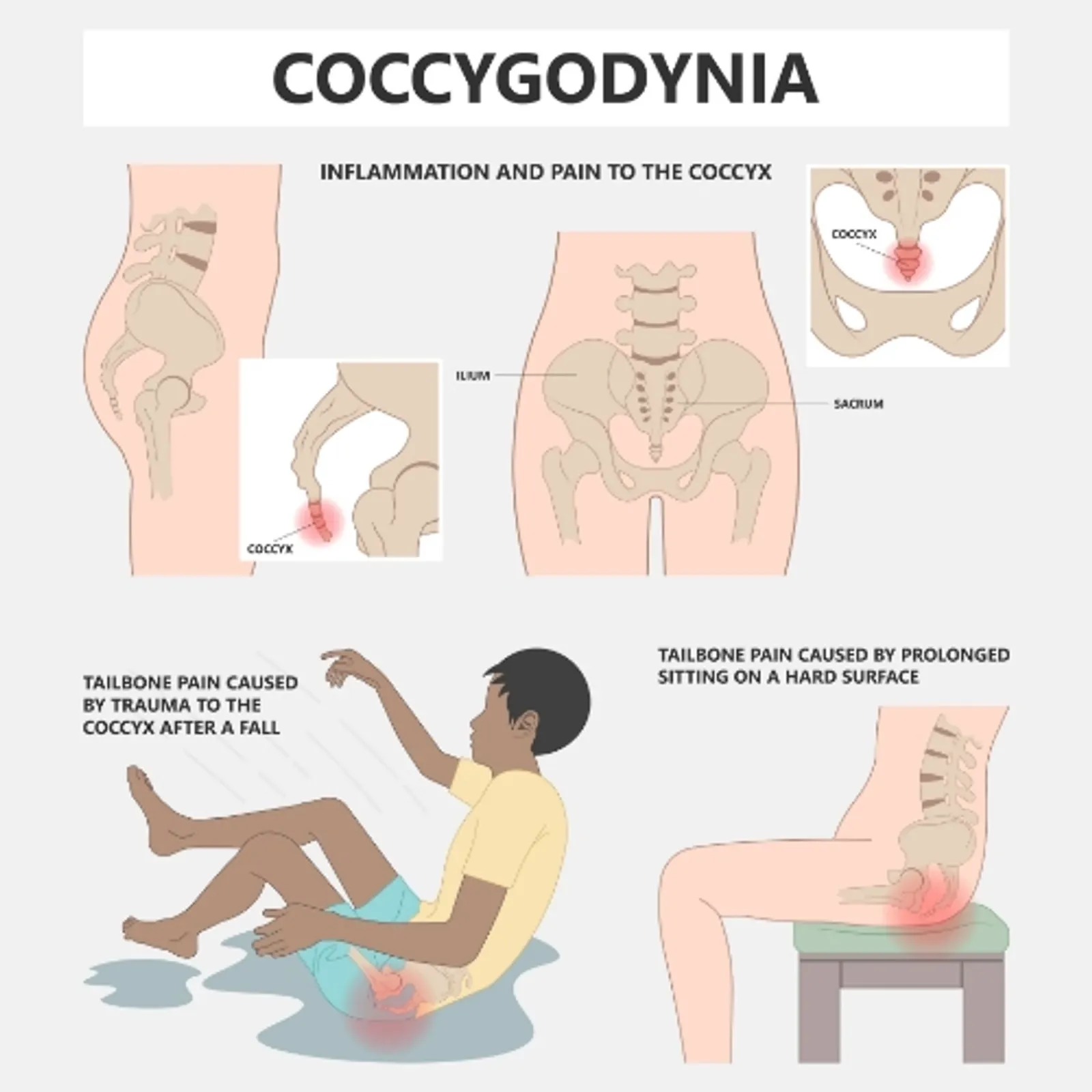 Causes des douleurs du coccyx.