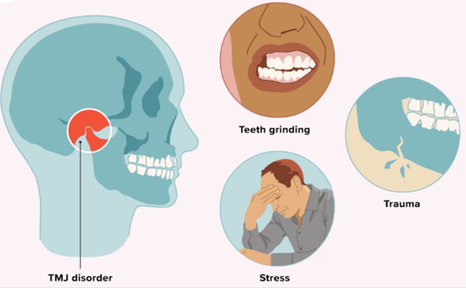 Causes mécaniques des douleurs aiguës de la mâchoire.