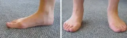 Biomechanical imbalance of the foot