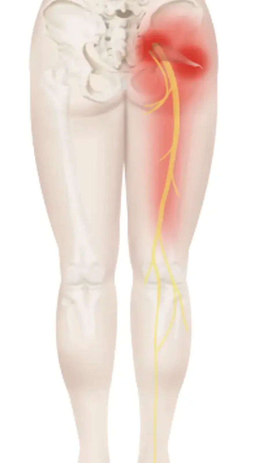 Topography of piriformis syndrome — a common and under-recognised cause of sciatica