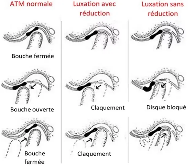 Diagram of disc displacement of the temporomandibular joint (TMJ) — osteopathic treatment