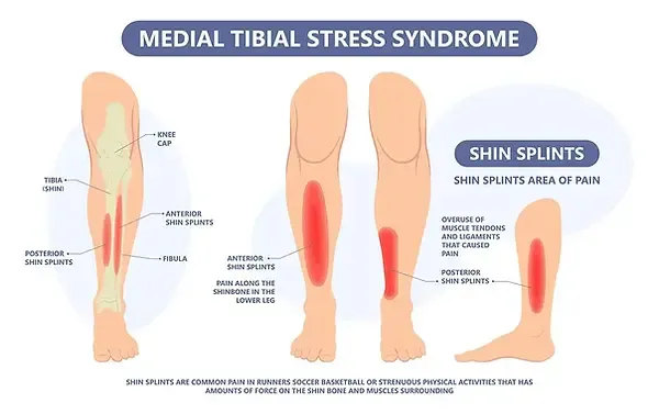 Shin splints in athletes
