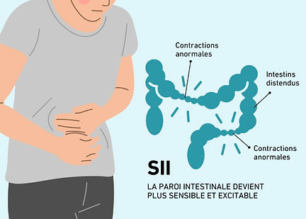 Physiopathologie du syndrome du côlon irritable