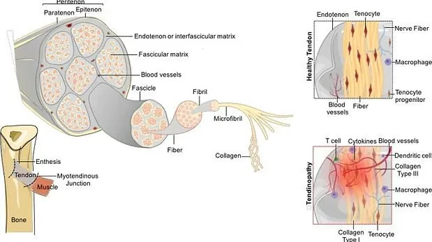 Pathophysiology of tendinopathies