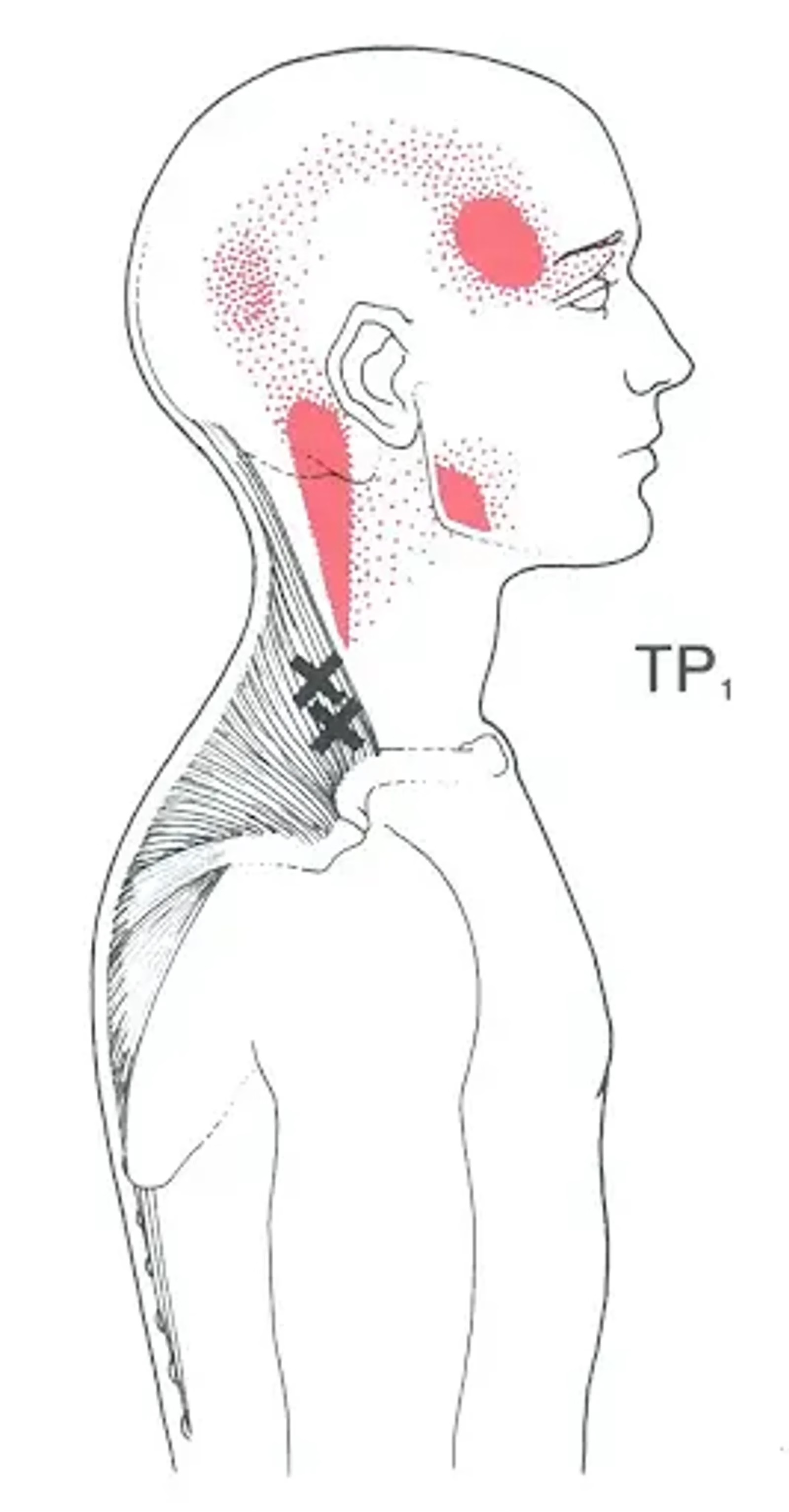 Trigger points of the trapezius