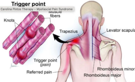 Explication du point gâchette dans le syndrome myofascial