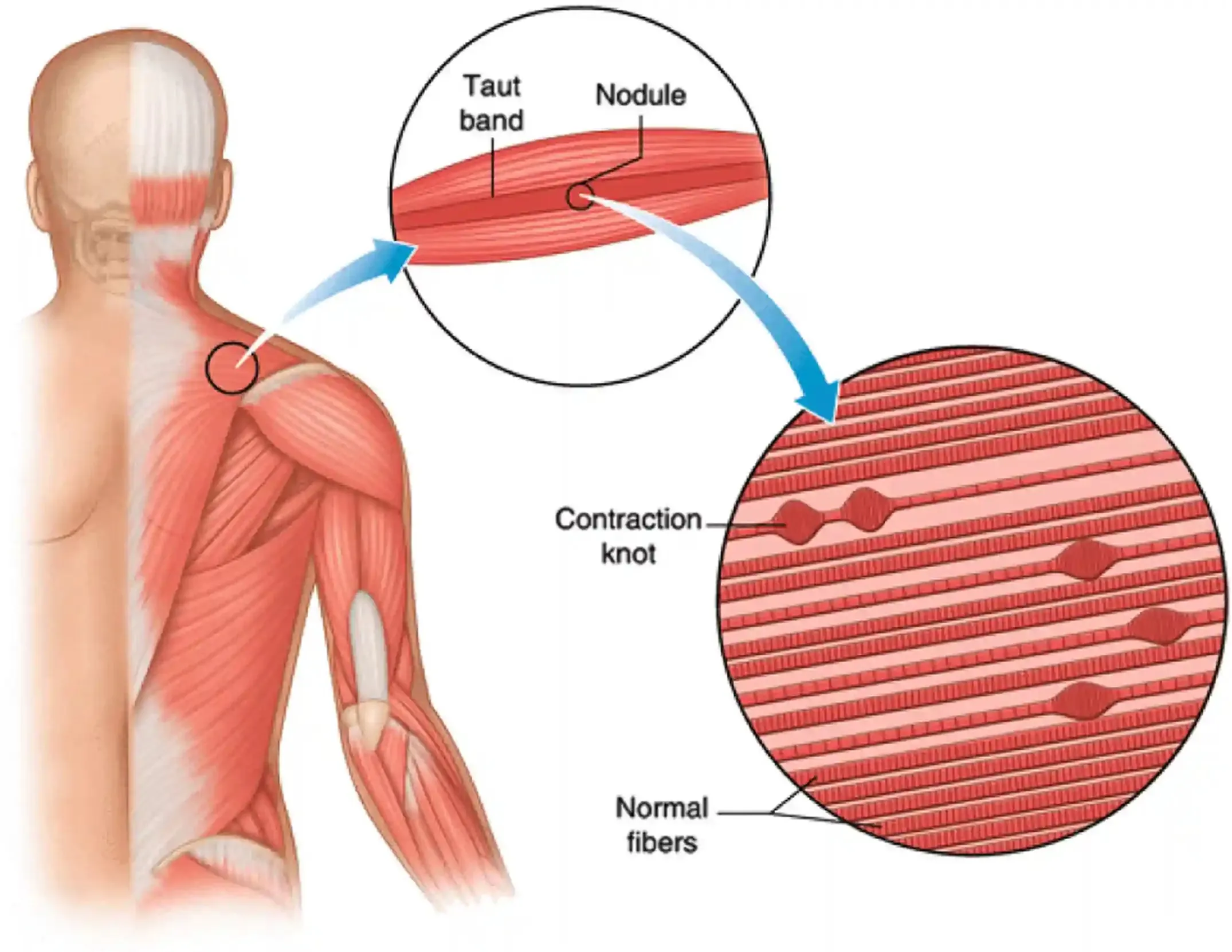 Explanatory diagram of trigger points by Charbel Kortbawi, osteopath in Paris 16