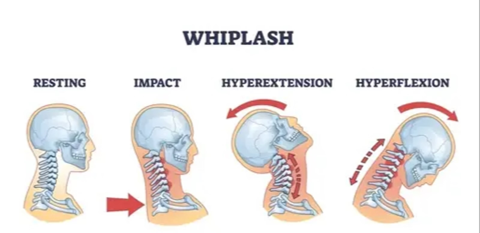 Schématisation d'un whiplash, effets sur le cou.