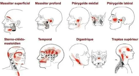 Myofascial trigger points, jaw pain and bruxism