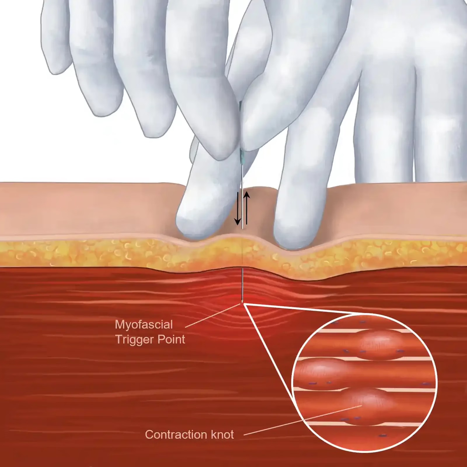 Dry needling technique applied to trigger points.