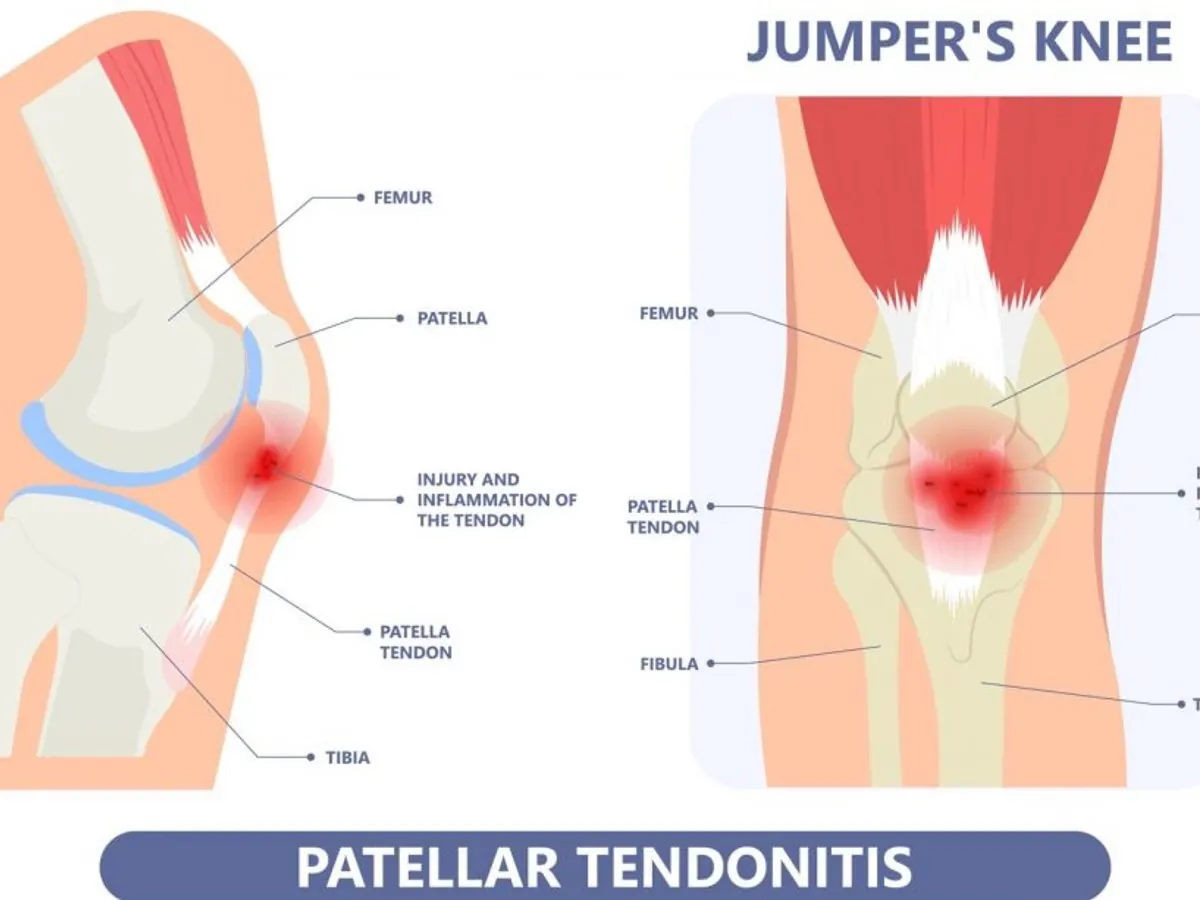 Patellar tendinopathy, osteopath Paris 16