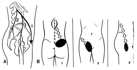 Osteopathic treatment of chronic pelvic pain, Paris 16