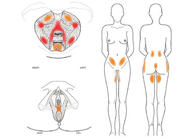 Traitement des points gâchettes du périnée chez la femme souffrant de douleur pelvienne chronique