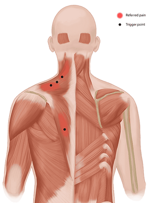 Syndrome myofascial, douleur référée et trigger point