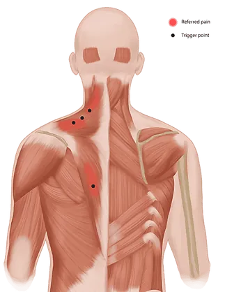 Myofascial pain syndrome, referred pain and trigger point
