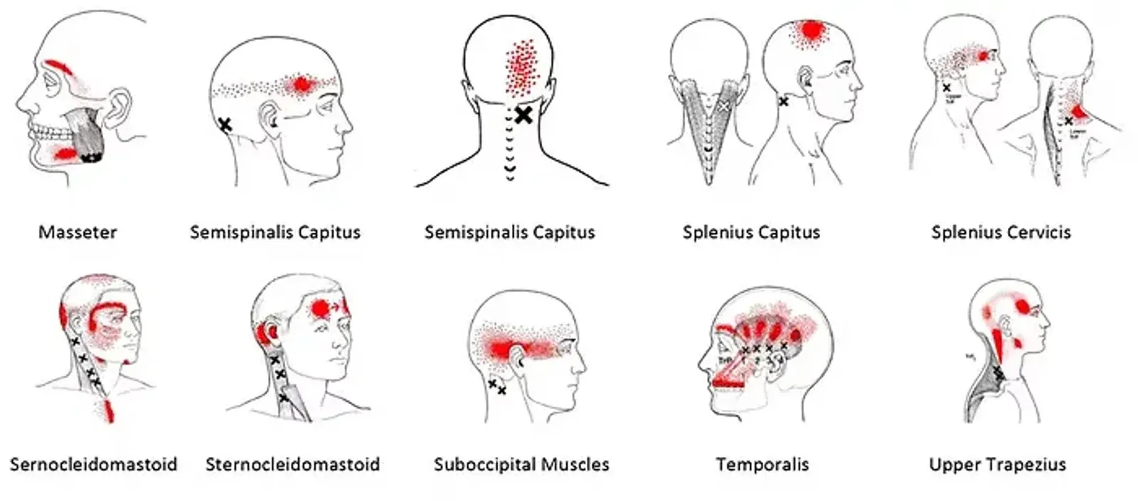 Trigger points liés à la douleur de la mâchoire, traitement par ostéopathie et thérapie manuelle
