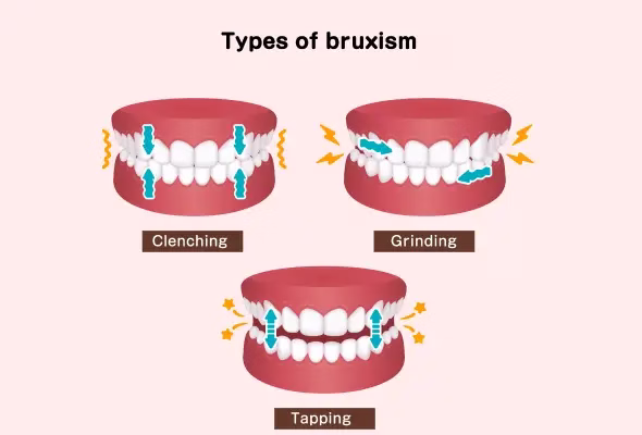 Les différents types de bruxisme : nocturne et d'éveil