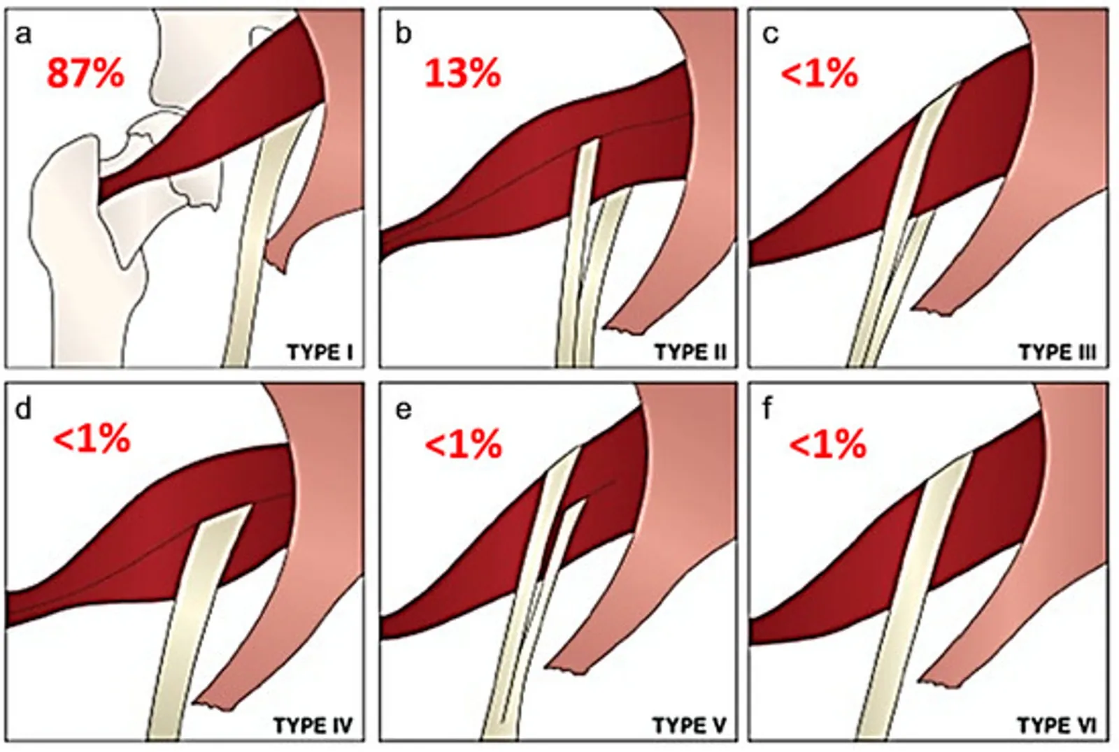 Anatomical variations of the piriformis muscle: sciatic nerve compression during hip flexion and rotation