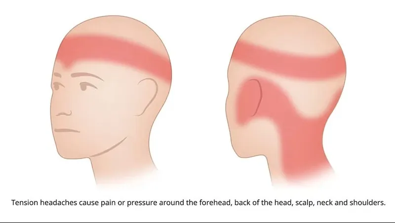 Zones de douleur typiques des céphalées de tension : front, arrière du crâne, cuir chevelu, cou et épaules